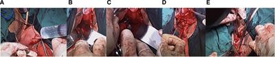 Effect of new-style anterior and posterior vaginal wall repair combined with modified ischial spine fascia fixation on patients with pelvic organ prolapse and their postoperative quality of life